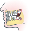wisdom teeth-24-664-727 wisdom teeth-24-664-727